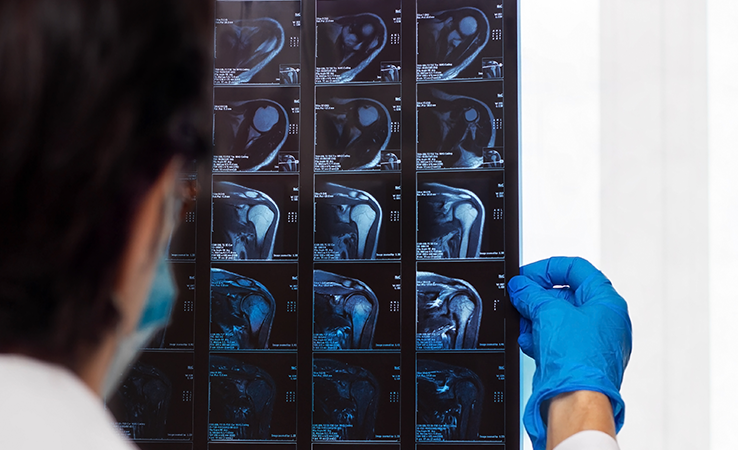 Who is a Suitable Candidate for Rotator Cuff Repair?